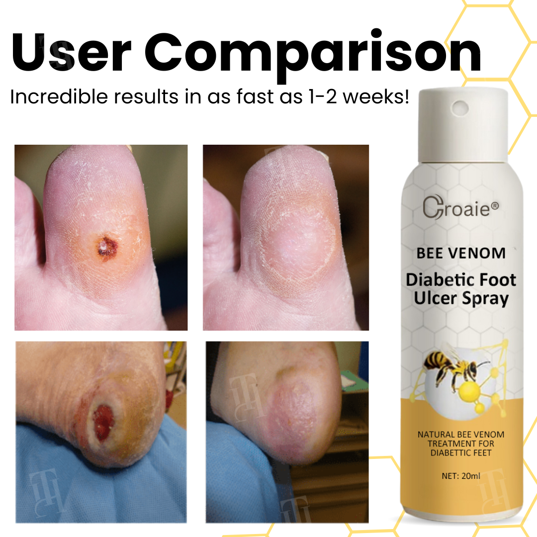 Croaieยฎ Bee Venom Diabetic Foot Ulcer Spray โ
๐๐ข๐ฌ๐ข๐๐ฅ๐ ๐ข๐ฆ๐ฉ๐ซ๐จ๐ฏ๐๐ฆ๐๐ง๐ญ ๐ข๐ง ๐-๐ ๐ฐ๐๐๐ค๐ฌโ