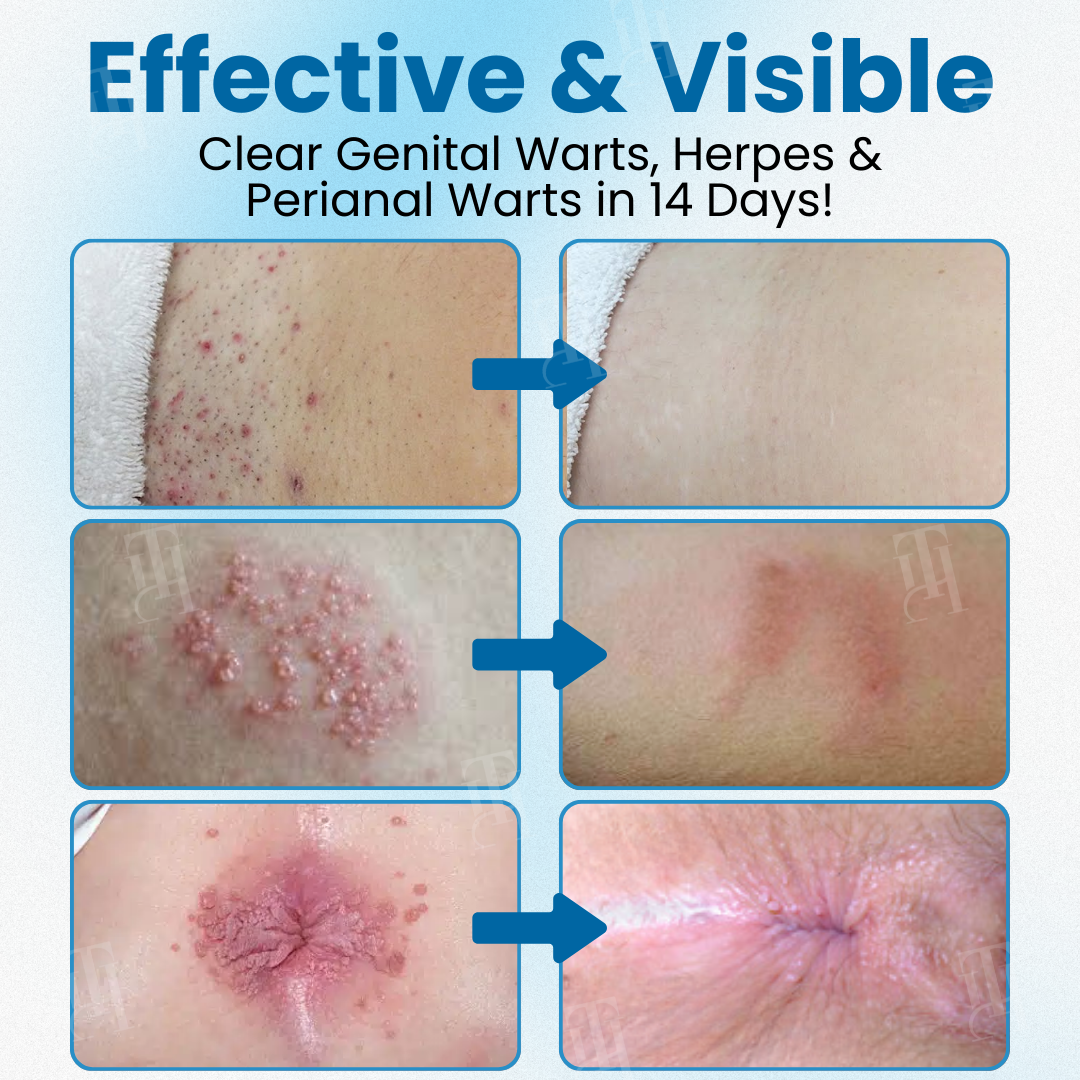 Croaie® Nanolipo Genital Warts Relief CreamðððšðŠð©ð¥ððð ððð§ð¢ððð¥ ððð¬ððšð«ððð¢ðšð§ ð¢ð§ ðð ððð²ð¬ð