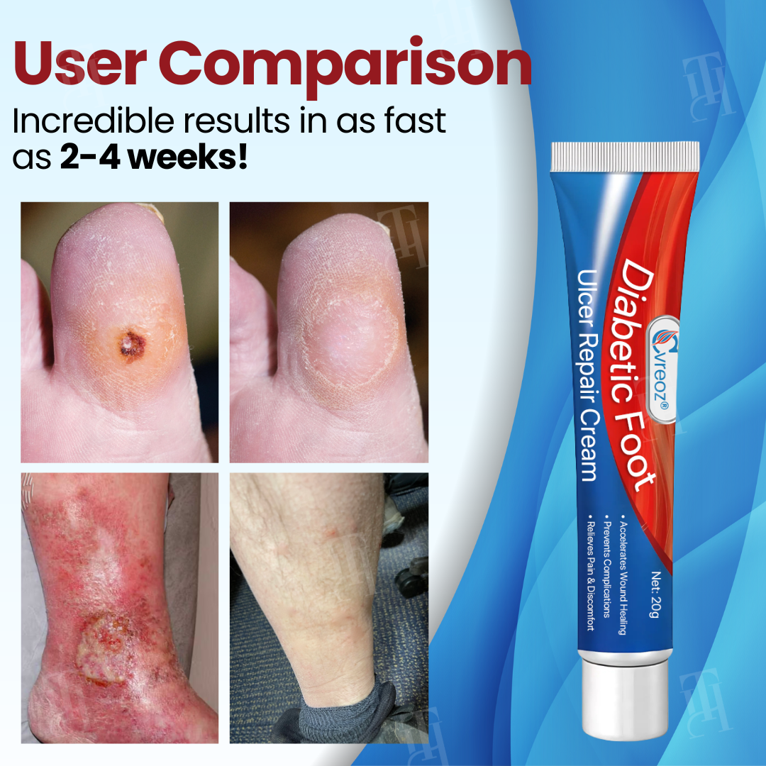 Cvreozยฎ Diabetic Foot Ulcer Repair Creamโจ๐๐๐ฏ๐ข๐ญ๐๐ฅ๐ข๐ณ๐ ๐๐จ๐ฎ๐ซ ๐
๐๐๐ญ ๐ข๐ง ๐๐๐๐ค๐ฌ!