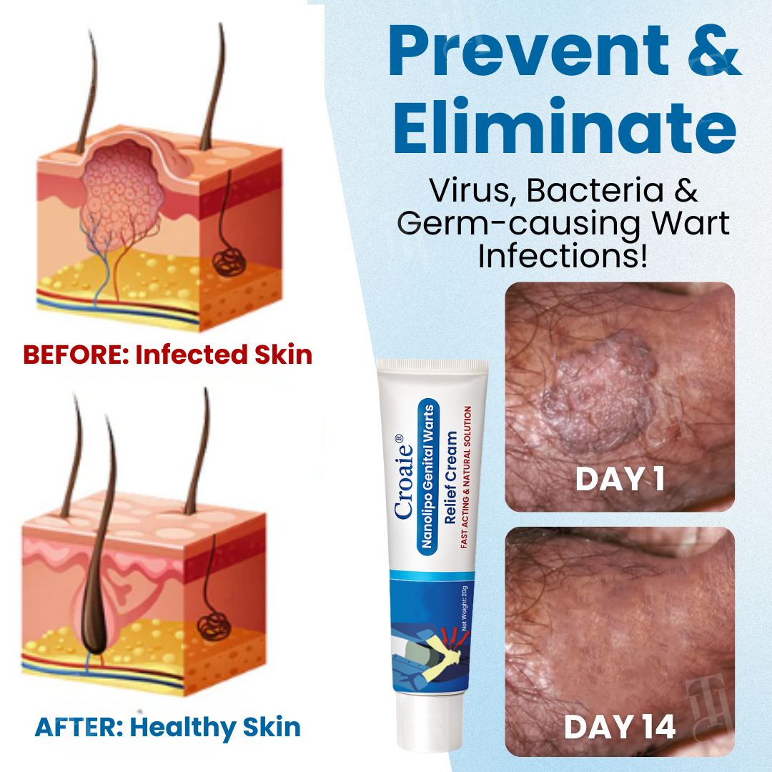 Croaie® Nanolipo Genital Warts Relief CreamðððšðŠð©ð¥ððð ððð§ð¢ððð¥ ððð¬ððšð«ððð¢ðšð§ ð¢ð§ ðð ððð²ð¬ð