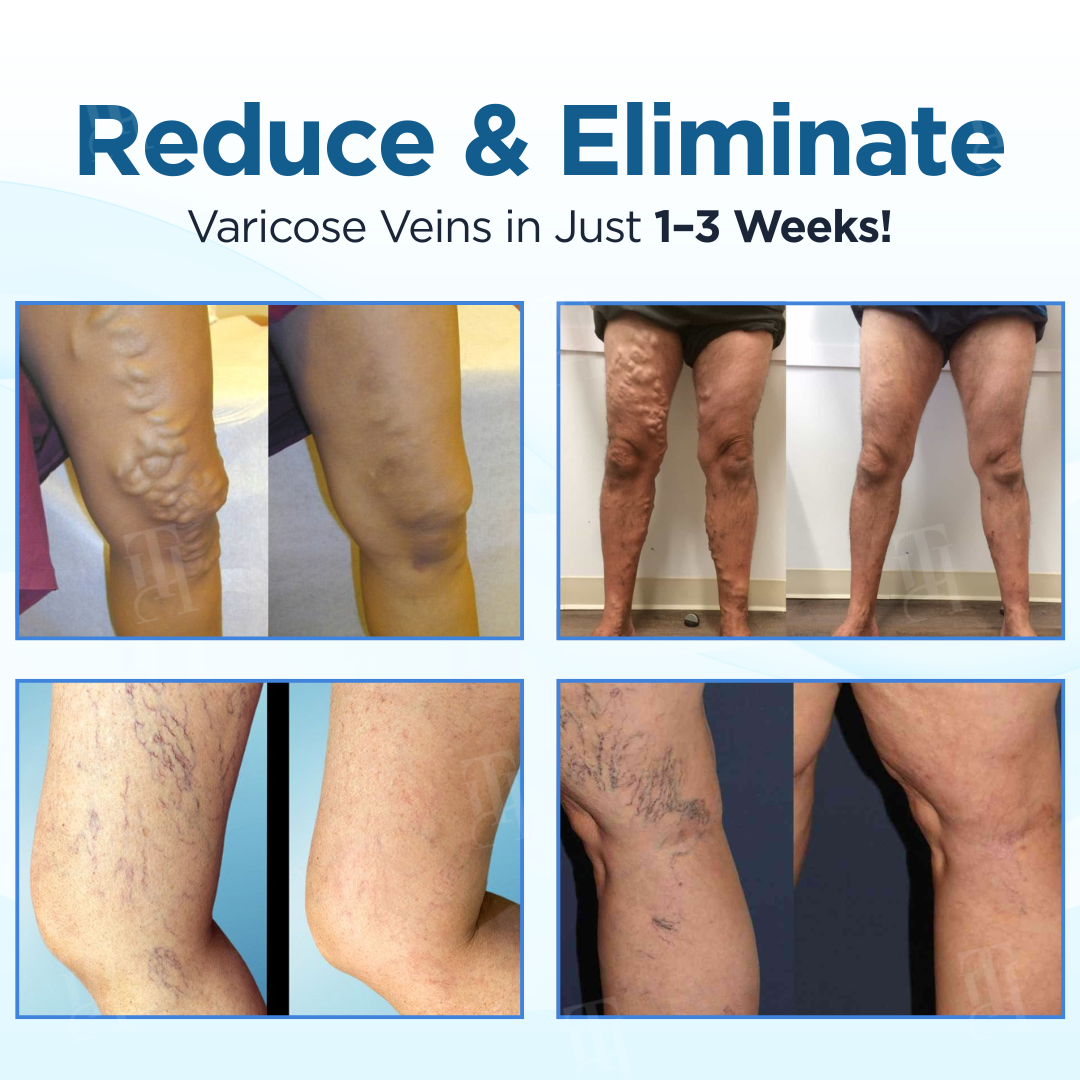 Cvreoz® Herbal Varicose Veins Treatment Spray ✅ Clinically proven to eliminate varicose veins in just 7 days!