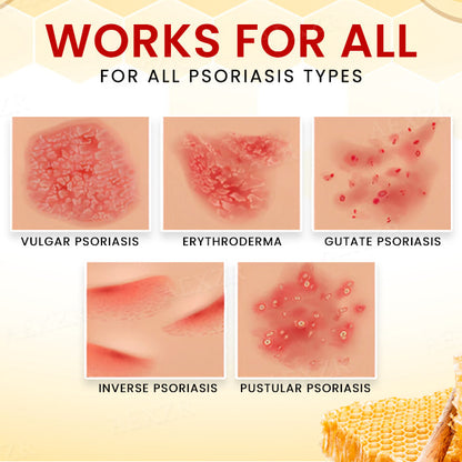Cvreoz® Bee Venom Psoriasis Treatment Cream