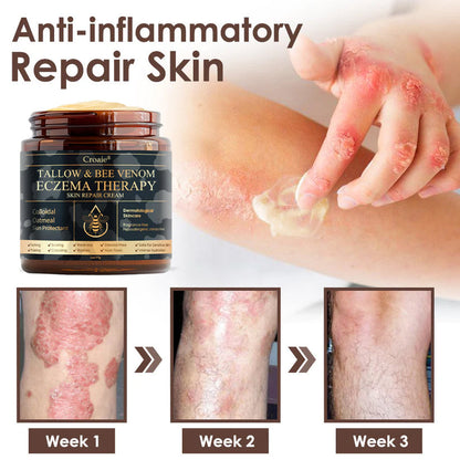 Croaie® Tallow & Bee venom Eczema Theraphy ✨ 𝐄𝐟𝐟𝐞𝐜𝐭𝐢𝐯𝐞 𝐑𝐞𝐥𝐢𝐞𝐟 𝐟𝐫𝐨𝐦 𝐄𝐜𝐳𝐞𝐦𝐚 𝐢𝐧 𝐉𝐮𝐬𝐭 𝟕 𝐃𝐚𝐲𝐬! ✨