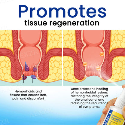 Cvreoz® Herbal Hemorrhoids Fast-Acting Treatment Spray