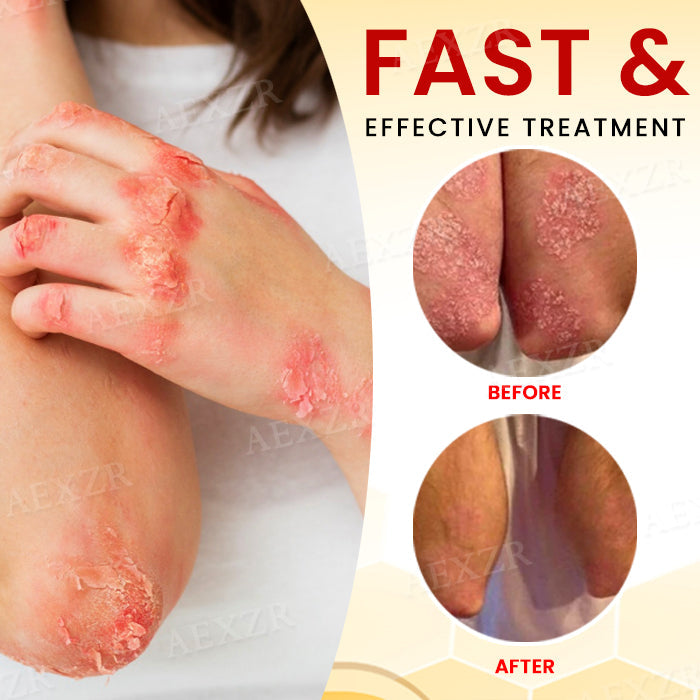 ⚡ New Year Flash Deals! 50% OFF - RZXEA™ Bee Venom Psoriasis Treatment Cream