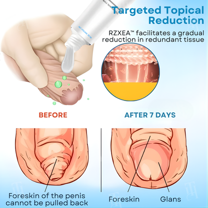 ⚡Stop discomfort & regain confidence fast, safe, and at home: RZXEA™ 7-Day Redundant Prepuce Corrective Gel