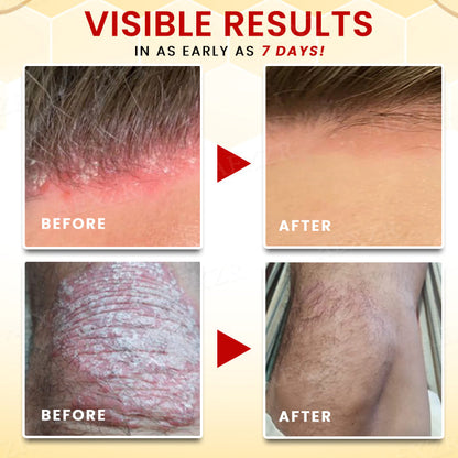 ⚡ New Year Flash Deals! 50% OFF - RZXEA™ Bee Venom Psoriasis Treatment Cream
