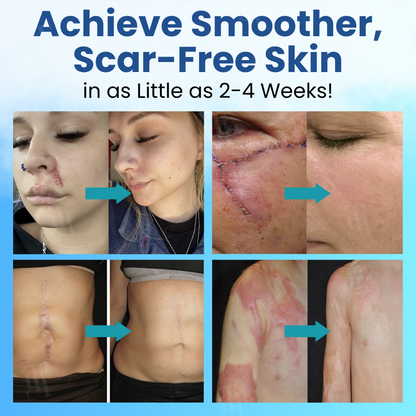 Cvreoz® Scar Vanquisher Aqua Gel