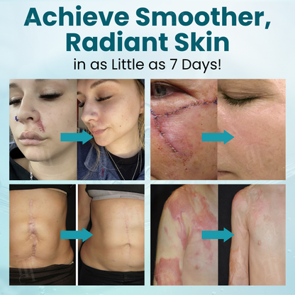 🚫Exclusive Patented Formula🚫Cvreoz® Advanced Scar Gel
