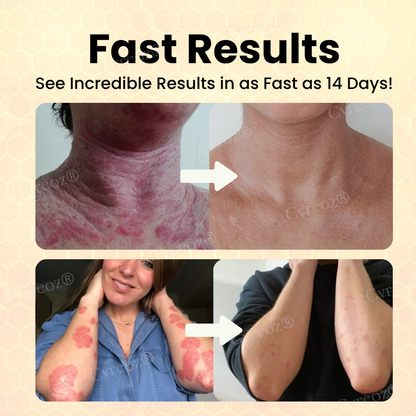 Cvreoz® Bee Venom Psoriasis Cream