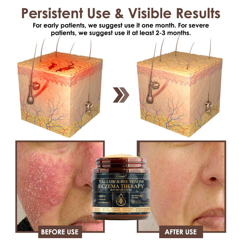 Croaie® Tallow & Bee venom Eczema Theraphy ✨ 𝐄𝐟𝐟𝐞𝐜𝐭𝐢𝐯𝐞 𝐑𝐞𝐥𝐢𝐞𝐟 𝐟𝐫𝐨𝐦 𝐄𝐜𝐳𝐞𝐦𝐚 𝐢𝐧 𝐉𝐮𝐬𝐭 𝟕 𝐃𝐚𝐲𝐬! ✨