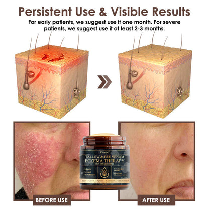 Croaie® Tallow & Bee venom Eczema Theraphy ✨ 𝐄𝐟𝐟𝐞𝐜𝐭𝐢𝐯𝐞 𝐑𝐞𝐥𝐢𝐞𝐟 𝐟𝐫𝐨𝐦 𝐄𝐜𝐳𝐞𝐦𝐚 𝐢𝐧 𝐉𝐮𝐬𝐭 𝟕 𝐃𝐚𝐲𝐬! ✨