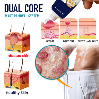 Cvreoz® Genital Warts Remover Cream