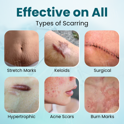 🚫Exclusive Patented Formula🚫Cvreoz® Advanced Scar Gel