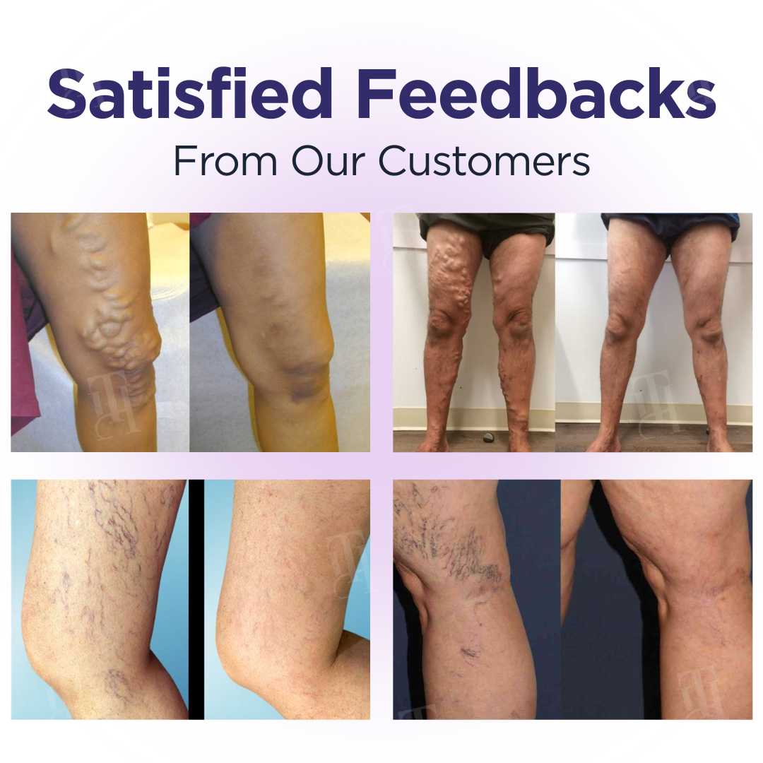 🦵 Say goodbye to varicose veins!🦵Cvreoz® DiaLeg Care Cream