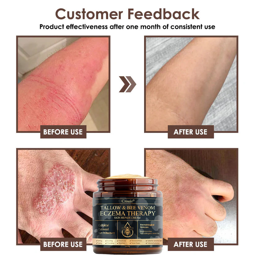 Croaie® Tallow & Bee venom Eczema Theraphy ✨ 𝐄𝐟𝐟𝐞𝐜𝐭𝐢𝐯𝐞 𝐑𝐞𝐥𝐢𝐞𝐟 𝐟𝐫𝐨𝐦 𝐄𝐜𝐳𝐞𝐦𝐚 𝐢𝐧 𝐉𝐮𝐬𝐭 𝟕 𝐃𝐚𝐲𝐬! ✨