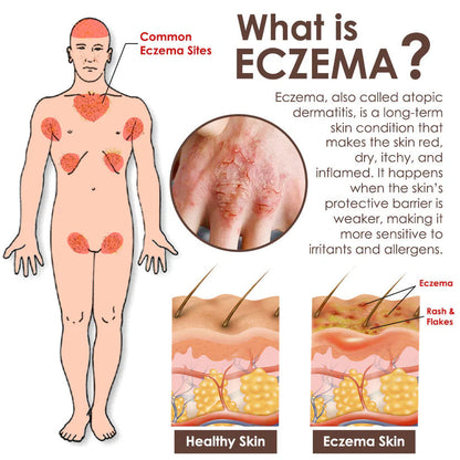Croaie® Tallow & Bee venom Eczema Theraphy ✨ 𝐄𝐟𝐟𝐞𝐜𝐭𝐢𝐯𝐞 𝐑𝐞𝐥𝐢𝐞𝐟 𝐟𝐫𝐨𝐦 𝐄𝐜𝐳𝐞𝐦𝐚 𝐢𝐧 𝐉𝐮𝐬𝐭 𝟕 𝐃𝐚𝐲𝐬! ✨