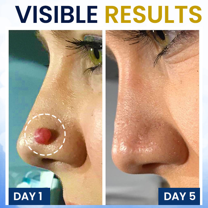 🏷️ EXCLUSIVE DEAL! 63% OFF - AEXZR® Skin Tag Cryo Treatment Spray