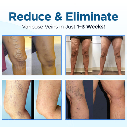 Cvreoz® Herbal Varicose Veins Treatment Spray ✅ Clinically proven to eliminate varicose veins in just 7 days!