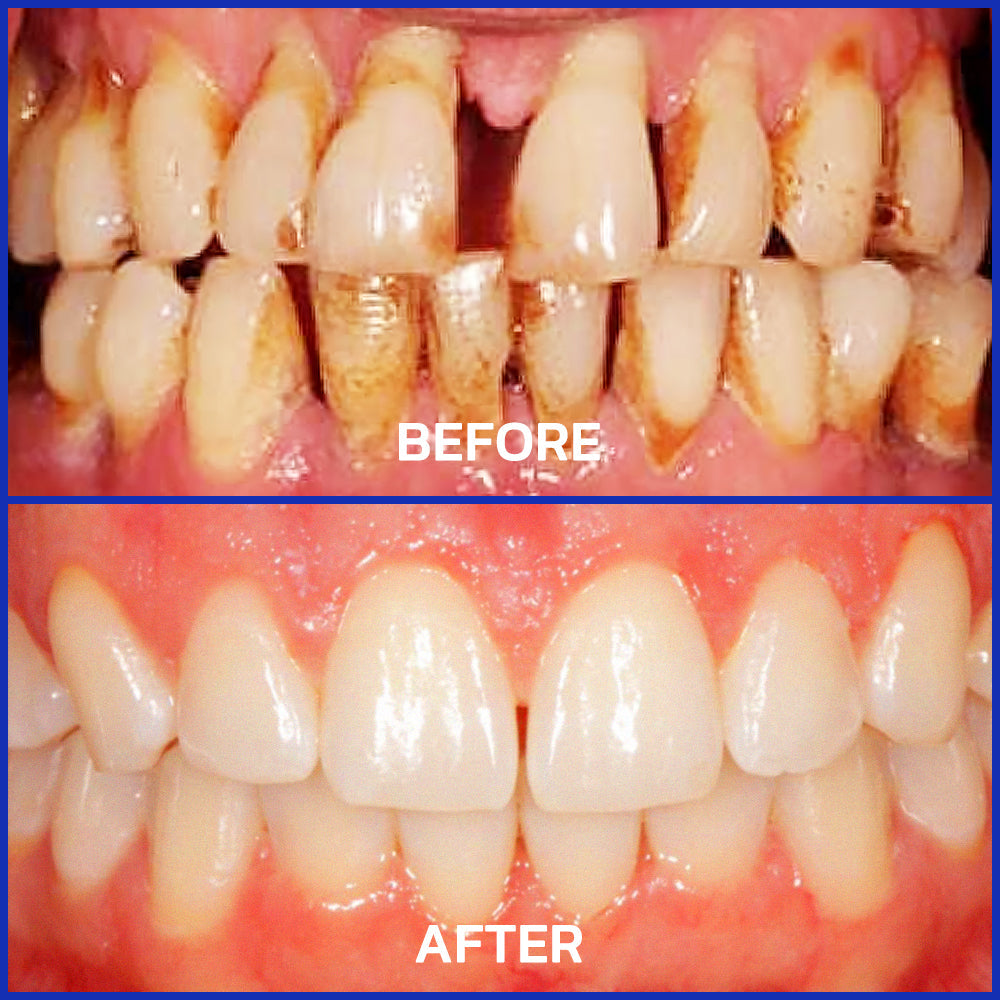 ⭐️[Official Store] AEXZR® Focussmile bee venom treatment powder for oral use🦷